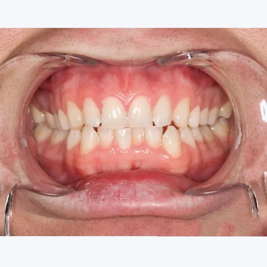 Ultradent Kleerview Retractors